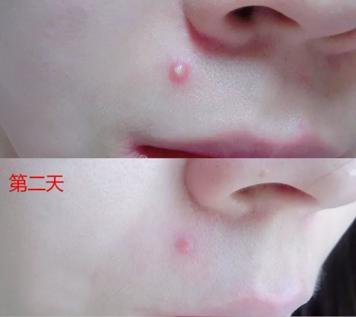 用什么洗脸抑制螨虫生长,用什么洗脸能够抑制螨虫生长