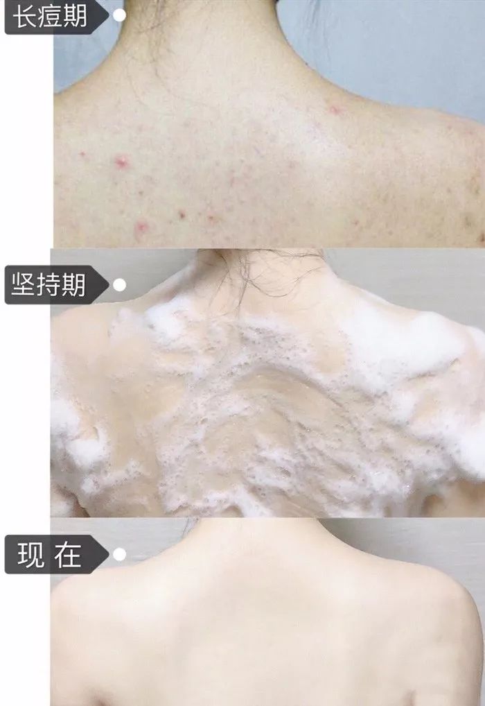 用什么洗脸抑制螨虫生长,用什么洗脸能够抑制螨虫生长