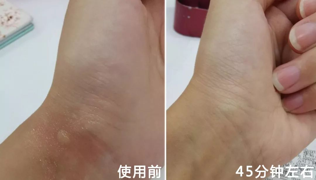 教你2分钟快速止痒,一小瓶止痒的药膏