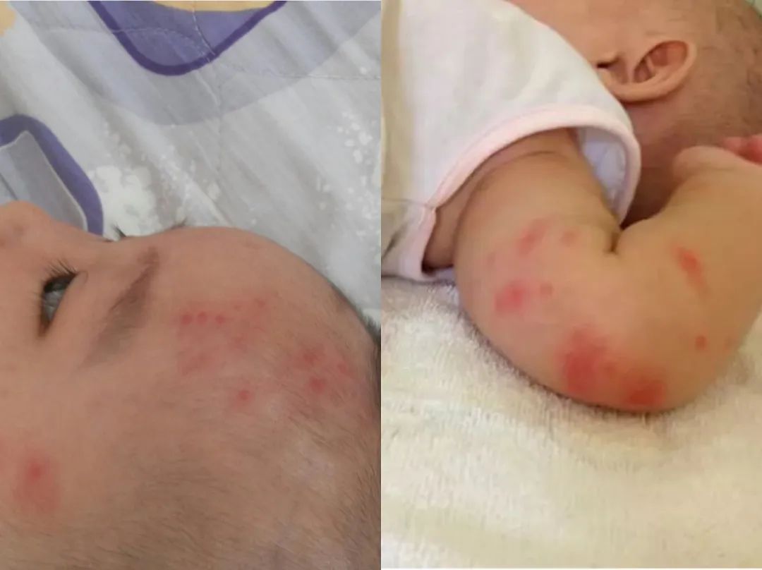 儿童驱蚊小神器,驱蚊神器防蚊又能止痒