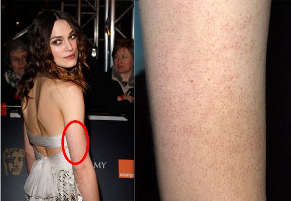 别放弃，烦人的“鸡皮疙瘩”，真的还能够再救一下