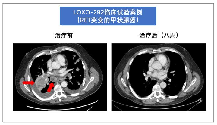 国内首款RET靶向药 (ret靶向药模仿版)