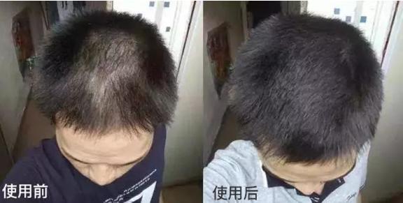 头皮痒头屑多有头螨怎么办,头螨大块头屑怎么治好得快