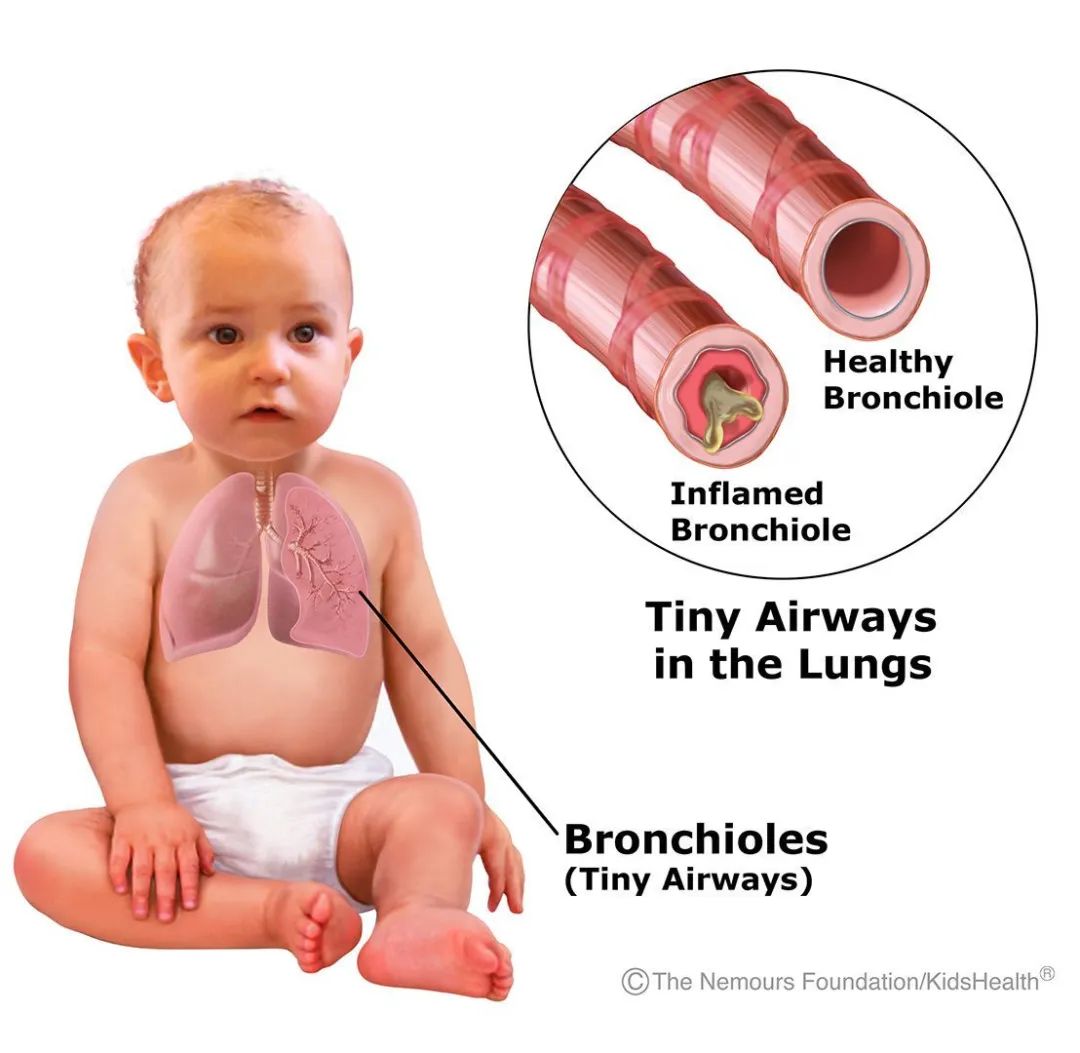 气道异物患者麻醉,小儿气道异物麻醉