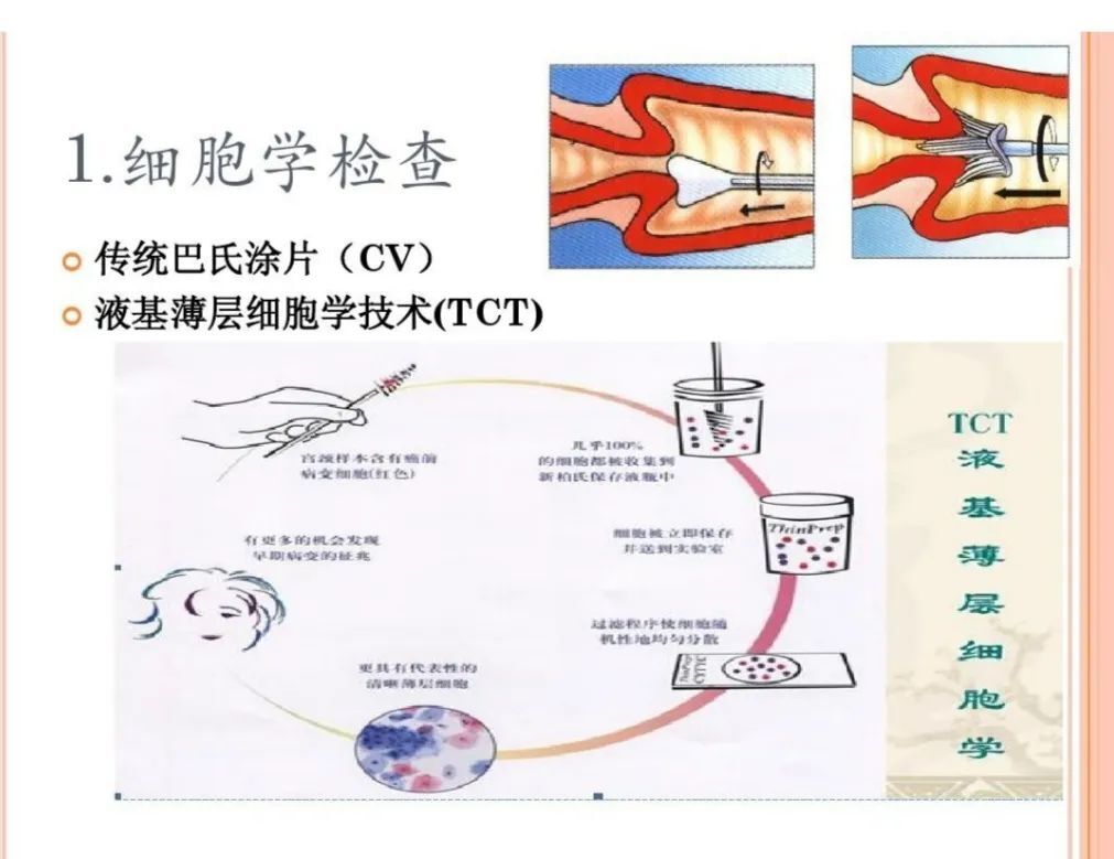 宫颈细胞学检查是怎么回事,宫颈细胞学检查di值超标