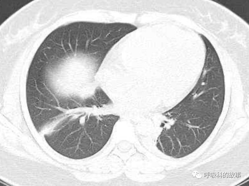 五花八门的发热之一—药物热（1）