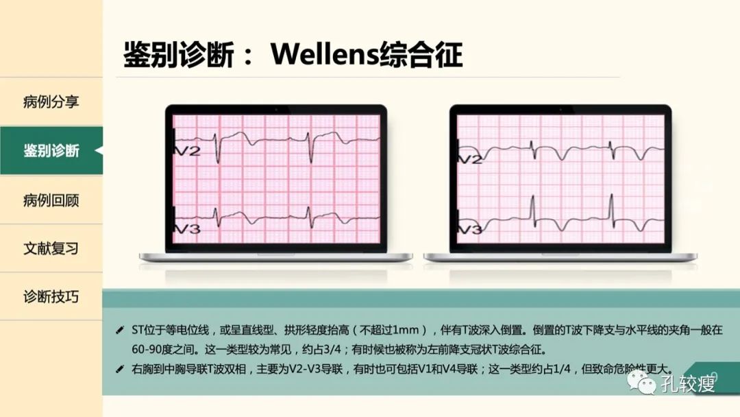 t波倒置在心电图中怎么看,T波低平心电图讲解