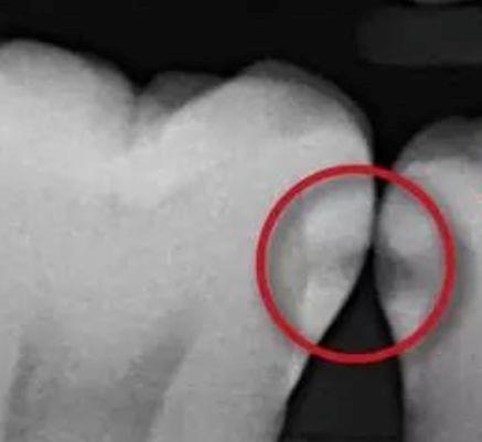 邻面龋能够变成静止龋吗,门牙邻面龋早期怎么处理