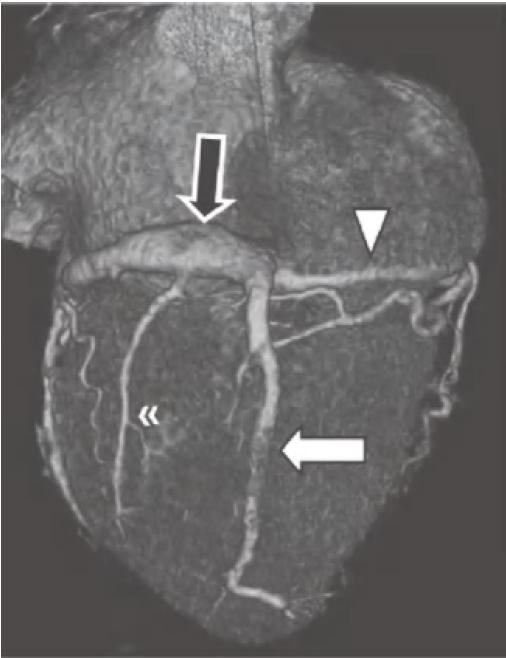 冠脉ct血管示意图的亮点是什么,冠脉血管造影识图