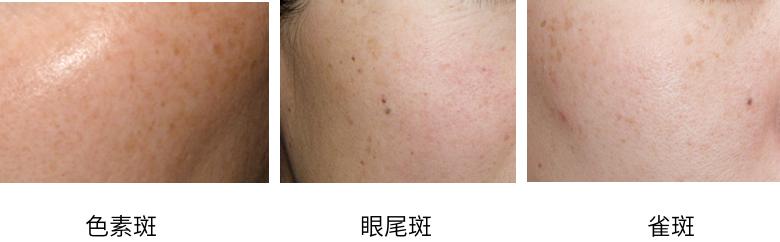 去斑点最有效方法医美去除斑痕,脸上暗沉有斑点能够做什么医美