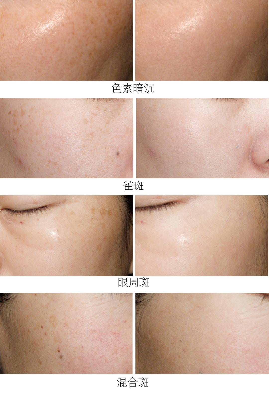 去斑点最有效方法医美去除斑痕,脸上暗沉有斑点能够做什么医美