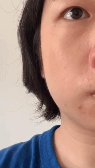去斑点最有效方法医美去除斑痕,脸上暗沉有斑点能够做什么医美