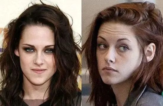 抬头纹眉间纹怎么去除,眉间纹抬头纹去除最好的方法