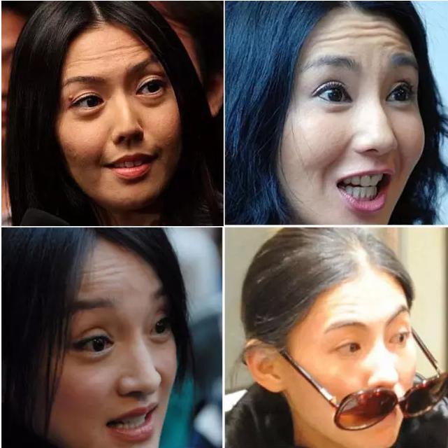 抬头纹眉间纹怎么去除,眉间纹抬头纹去除最好的方法