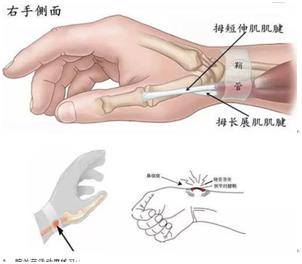 手腕劳累过度疼痛怎么治疗最快,手腕过度劳累疼痛怎么治疗最快