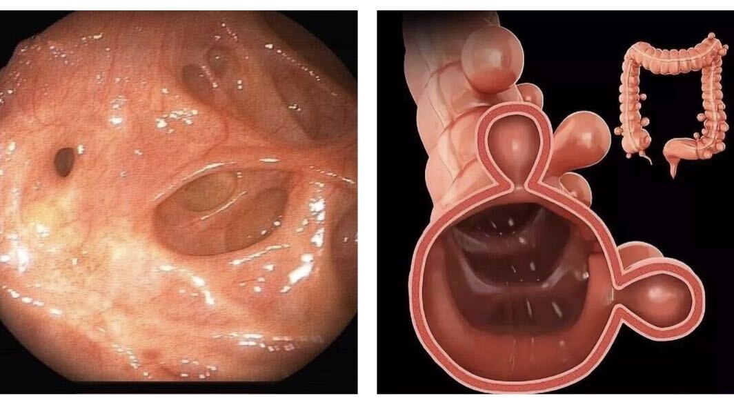科普系列-七旬大爷腹痛、便血来诊，是肠癌？肠道“隐形杀手”——结肠憩室