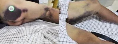 华法林过量引起出血用什么解救,华法林过量凝血表现