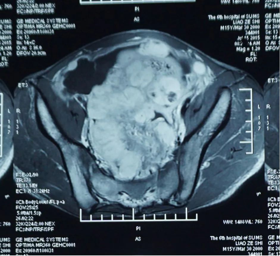 肌纤维母细胞瘤告捷案例,炎性肌纤维母细胞瘤最佳治疗方案