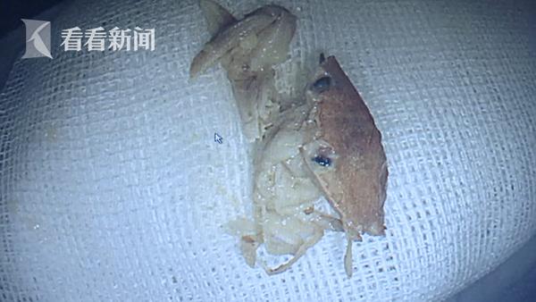 女子吞了一整只螃蟹,女子吃螃蟹被螃蟹腿吸住