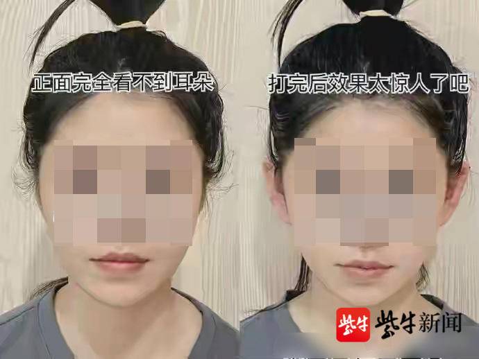 耳朵太大能够做整形变小么,如何让耳朵变成精灵耳