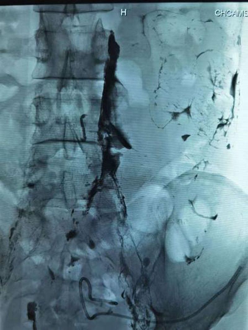 微创免费治疗告捷案例,微创淋巴手术