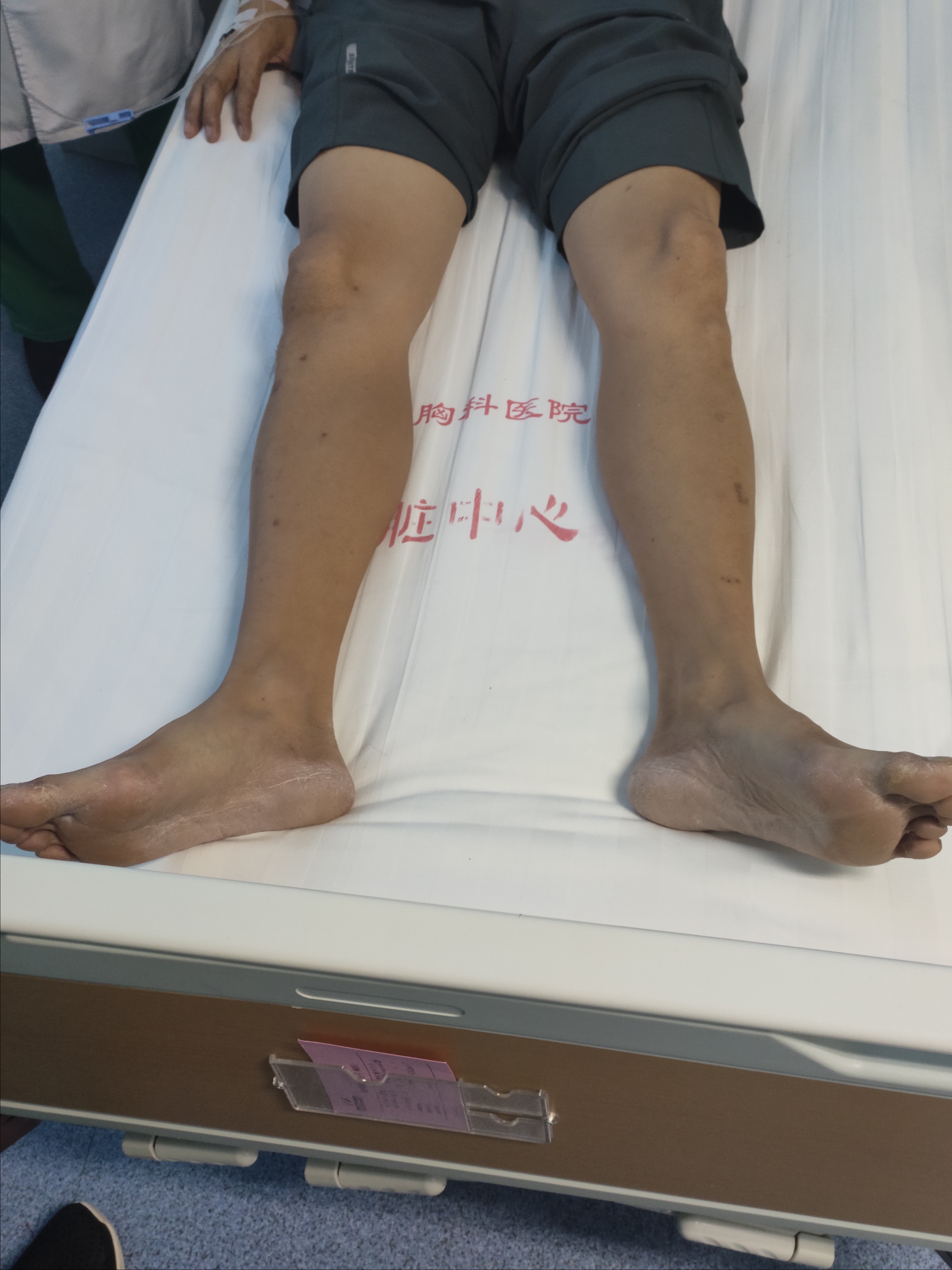 傲娇大叔高血压十多年不吃药，身体变水球下肢肿成大象腿