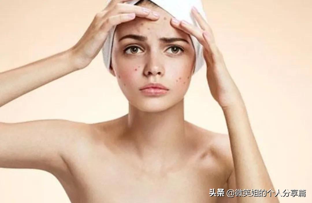 脑门一直长闭口长痘什么原因,人中长痘闭口怎么办