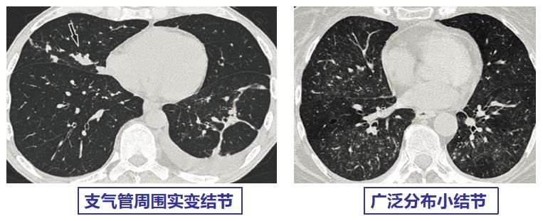 行家讲新冠二次感染的情况讲解,感染新冠行家怎么说