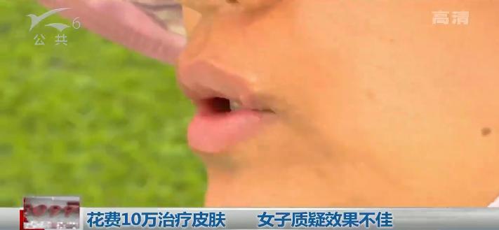 去除唇周黑在医院花多少钱,医院人员说不能够退款怎么办