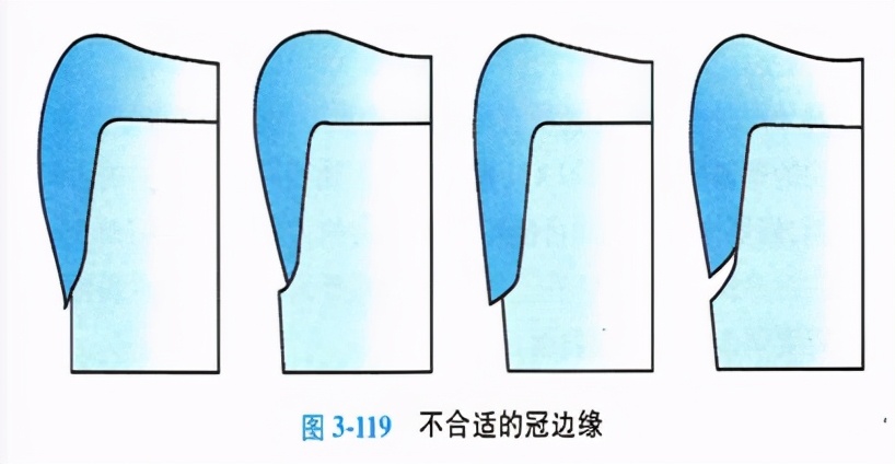 牙齿缺损粘接修复术和简单填充术,牙科义齿修复零基础教学