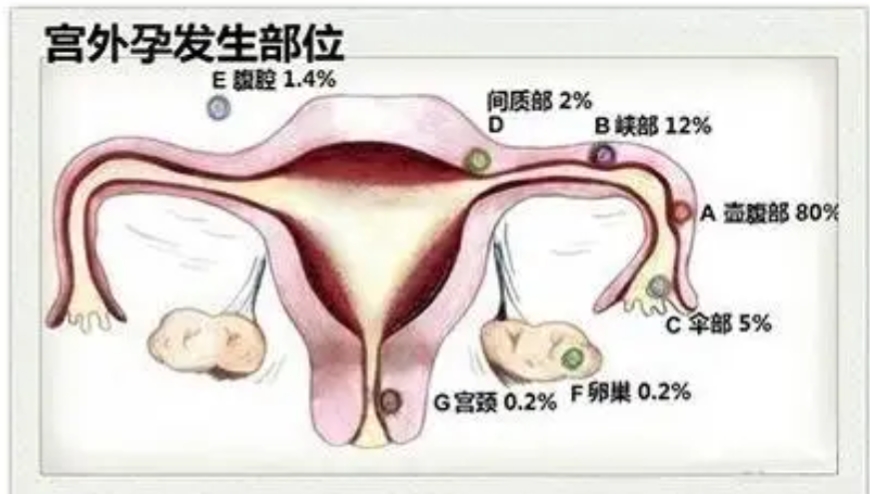 宫外孕术后怀孕几率是多少,复通术后宫外孕还能再怀孕吗