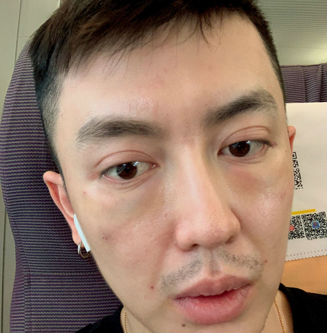 整形到底是失败还是毁容,美容变毁容完全版