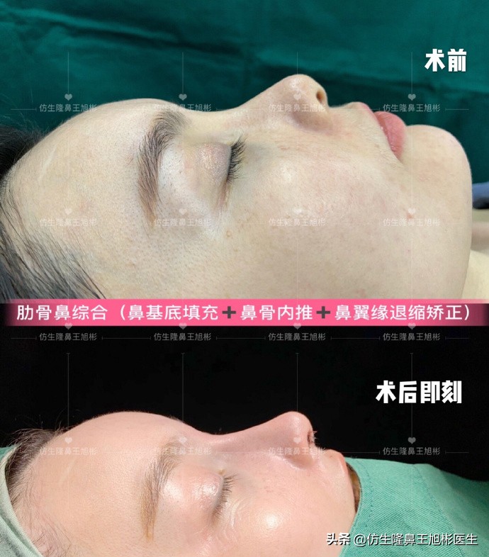 耳软骨隆鼻鼻小柱也是用耳软骨吗,耳软骨隆鼻能够摸到鼻尖的软骨吗