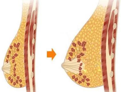 自体脂肪隆胸两年后的忠告,平胸能够做自体脂肪隆胸吗