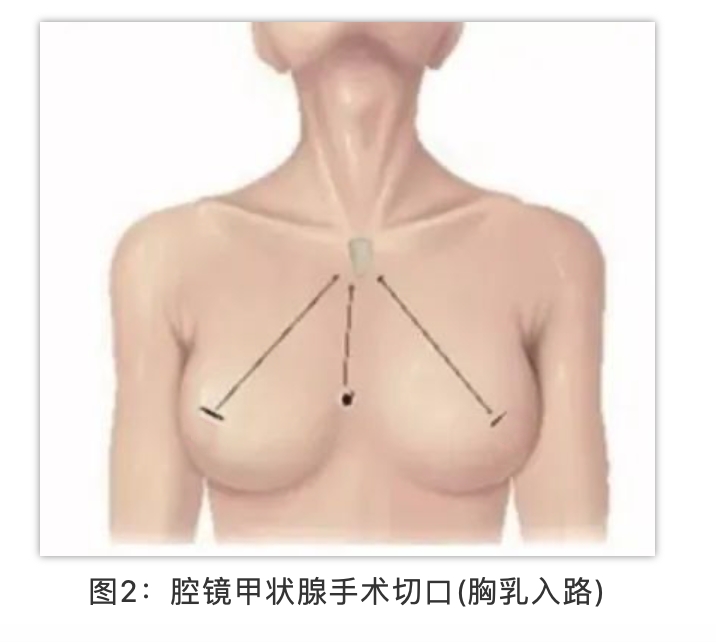 做甲状腺留疤怎么办,做甲状腺手术有哪些危险