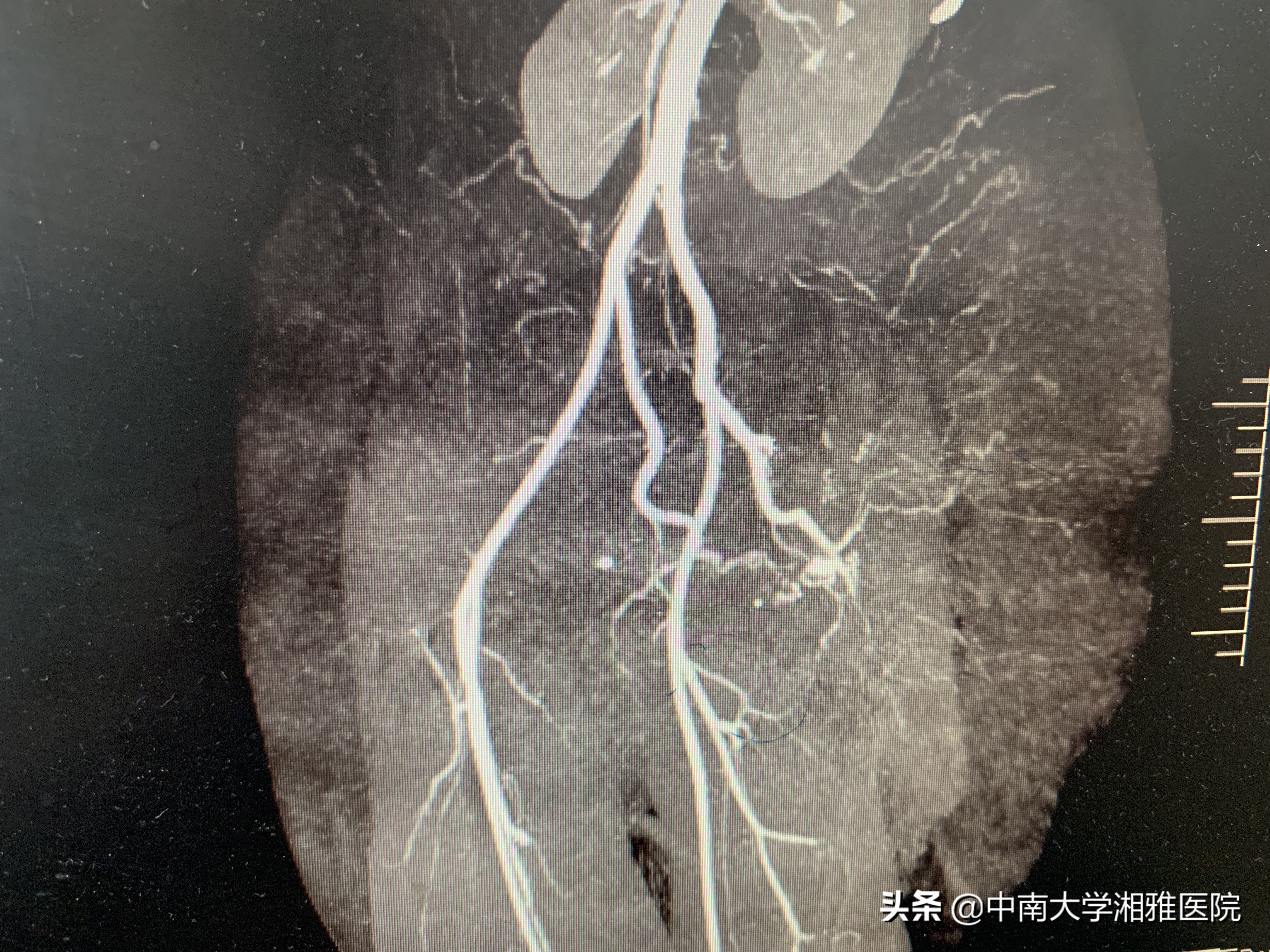 女子手术切除巨大肿瘤后续,女子切除50多斤肿瘤