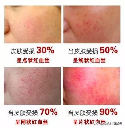 硫磺皂真的能够祛痘吗,硫磺皂真的能祛痘除螨吗