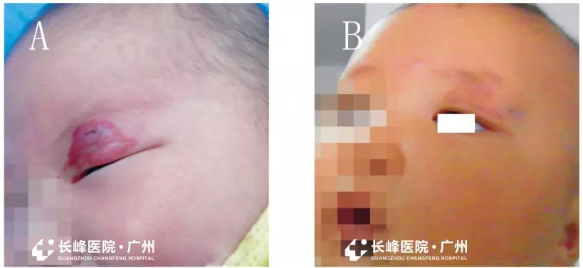 眼部血管瘤会变癌吗,眼睛血管瘤造成失明能够恢复吗
