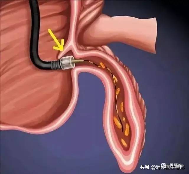 阑尾炎不开刀还有其他办法,治疗阑尾炎的最好的治愈方法