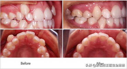 牙齿正畸前后变化大吗？带你看牙齿矫正变化图