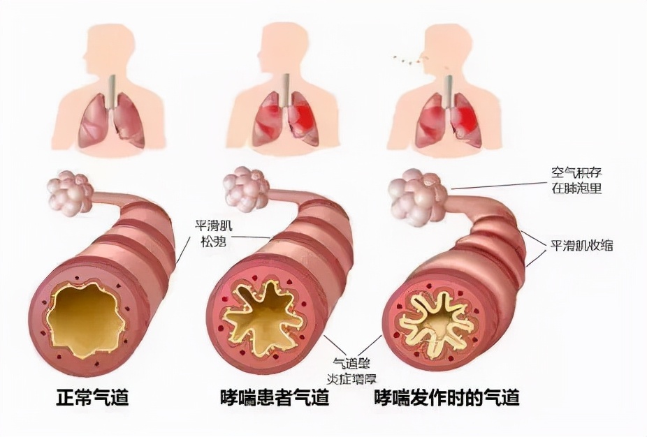 妊娠期哮喘用药指南,哮喘急性发作您需要知道的知识