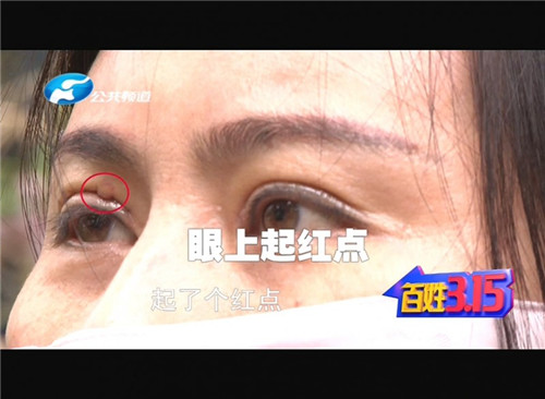 割双眼皮线没有拆干净出脓包了,郑州东方整形医院双眼皮告捷案例
