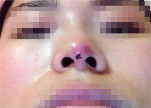 修复隆鼻失败手术,隆鼻后失败