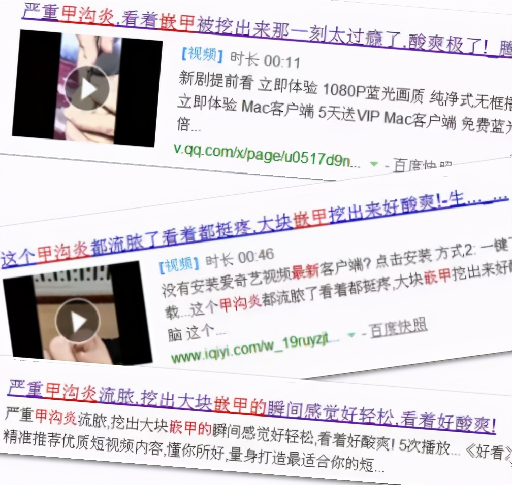 拔甲能够彻底治好嵌甲性甲沟炎吗,嵌甲甲沟炎拔了指甲还是红肿有脓