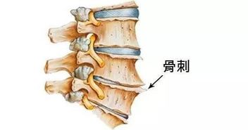 滑膜炎骨刺骨质增生怎么治,膝盖骨质增生长骨刺怎么治