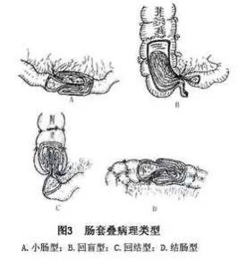 小儿肠套叠是什么原因发生的,小儿肠套叠有哪些症状表现