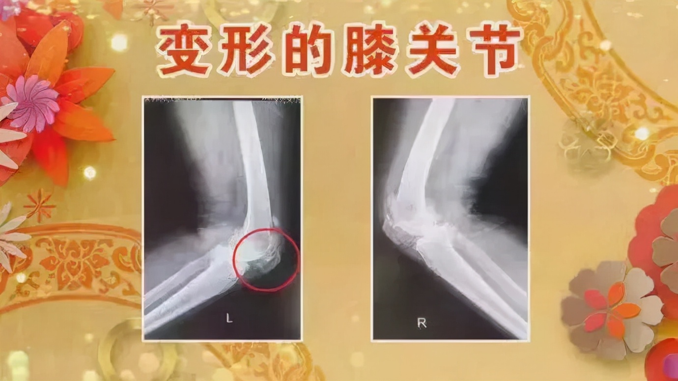 半月板损伤最怕什么药,半月板最怕三种药