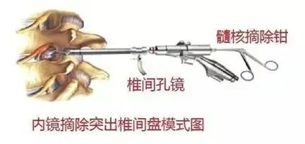 腰疼腿不疼会是椎间盘突出吗,椎间盘突出引起的腰痛怎么治
