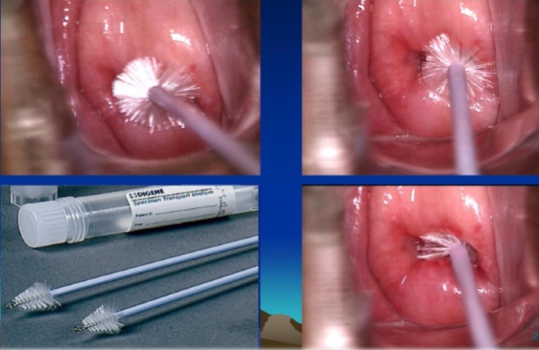 见HPV色变？女性都应了解的HPV真相