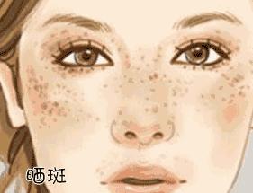 化妆品祛斑和激光祛斑哪个效果好,祛斑能够去医院但不要激光祛斑